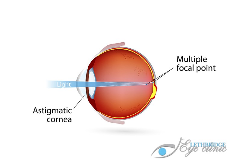 Astigmatism Lethbridge