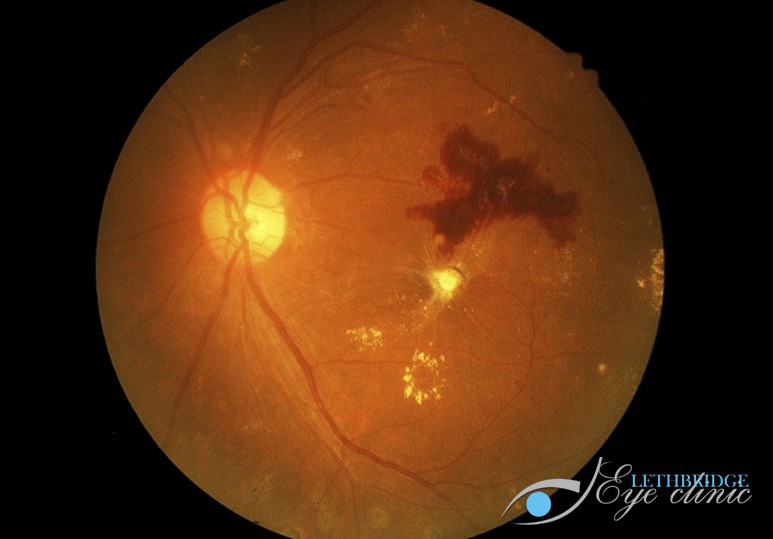 Diabetic Retinopathy Lethbridge