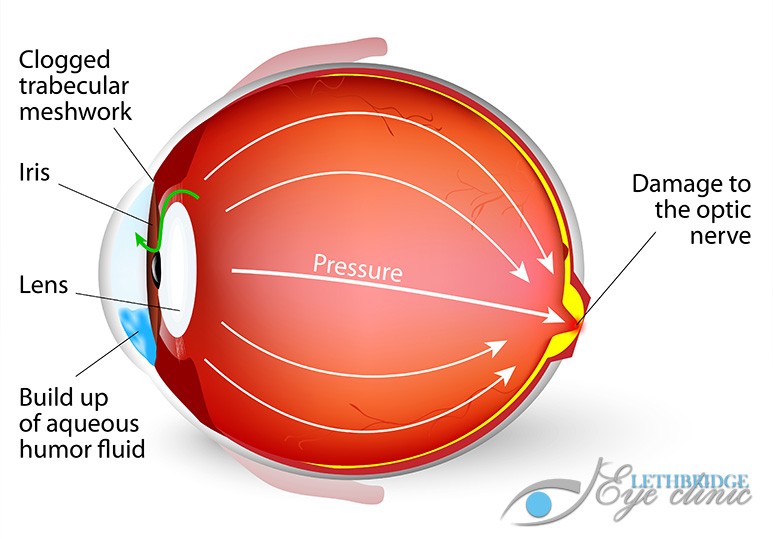 Glaucoma Lethbridge