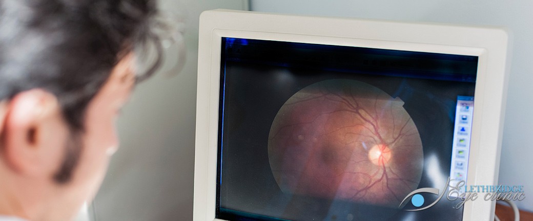 Glaucoma Testing Lethbridge